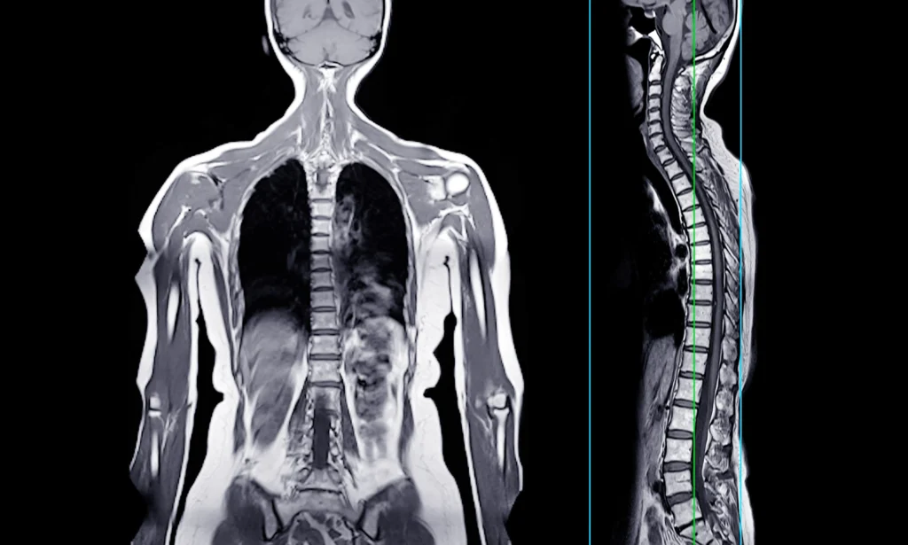 visão comparativa de exames de imagem mostrando a coluna vertebral completa em planos frontal e lateral, essenciais na ressonância para dor lombar.
